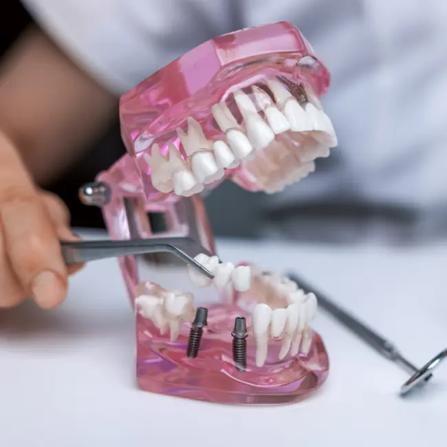 All-on-X dental implant model for full-arch treatment planning